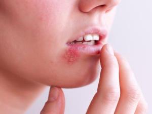 Aphthous Ulcers and Herpes Lesions