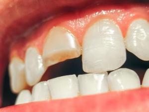 Treatment of Short and Fractured Teeth